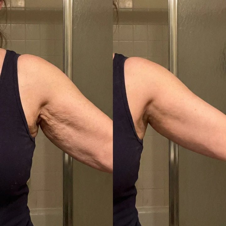 Fotografie comparativa a bratului, inainte si dupa