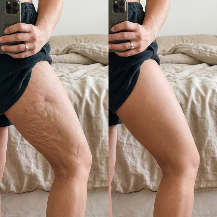 Fotografie comparativa a coapsei, inainte si dupa
